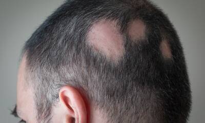 Alopecia areata