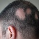 Alopecia areata