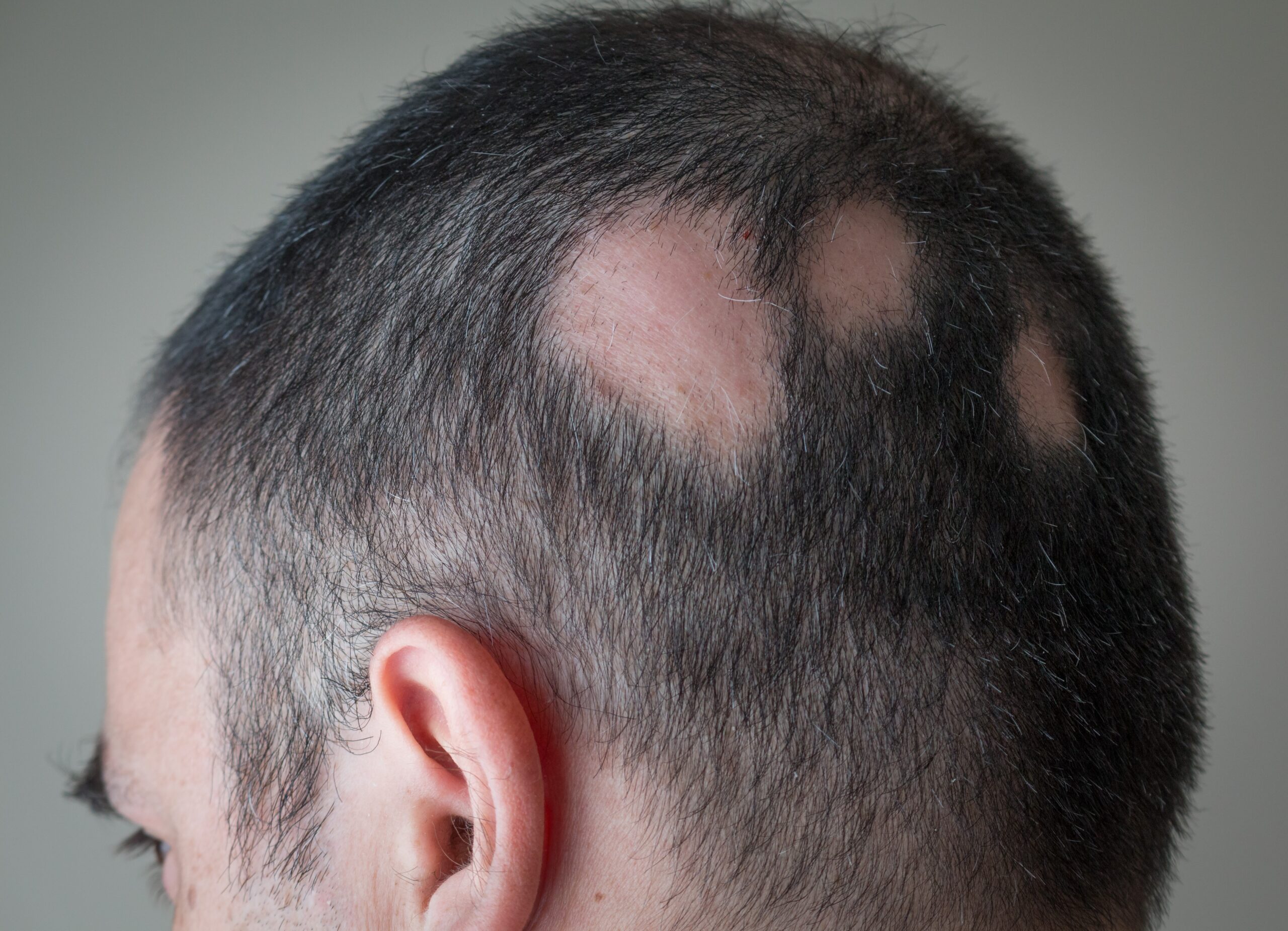 Alopecia areata scaled